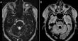 Chinese Neurosurgical Journal Reports Novel Surgical Approach for Refractory MS-Related Trigeminal Neuralgia