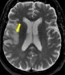 A Chinese Neurosurgical Journal’s study Identifies a Risk Factor for Post-Surgical Stroke in Moyamoya Disease