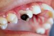 DNA and RNA Sequencing Reveal the Real Culprit Behind Severe Early Childhood Caries