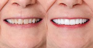 Before and After Dental Work in Puerto Vallarta Mexico