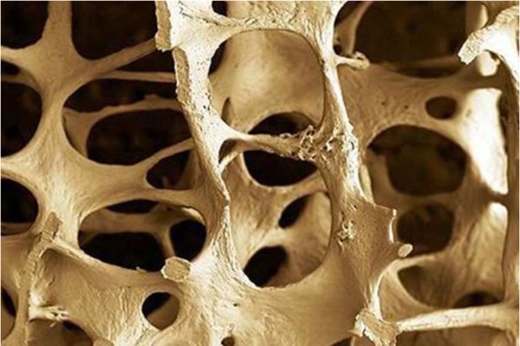 A New Way to Build Stronger Bones: Blocking Axl Shows Promise