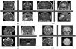 Scientists develop a two-step system for detecting and classifying brain tumors from MRI images