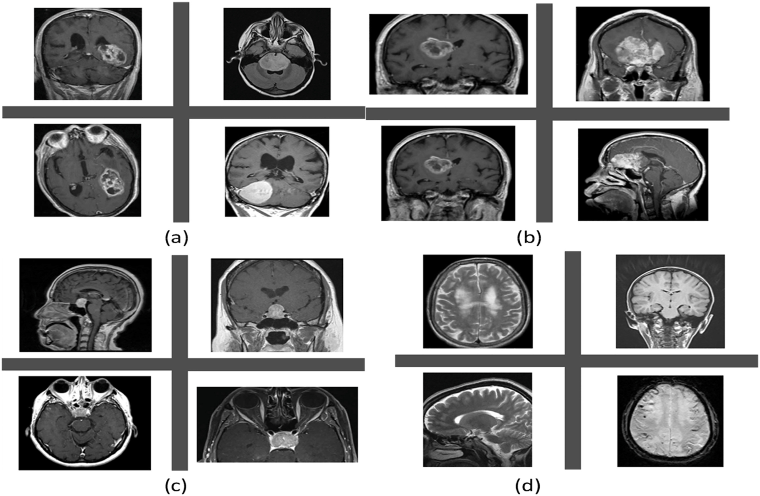 Scientists develop a two-step system for detecting and classifying brain tumors from MRI images
