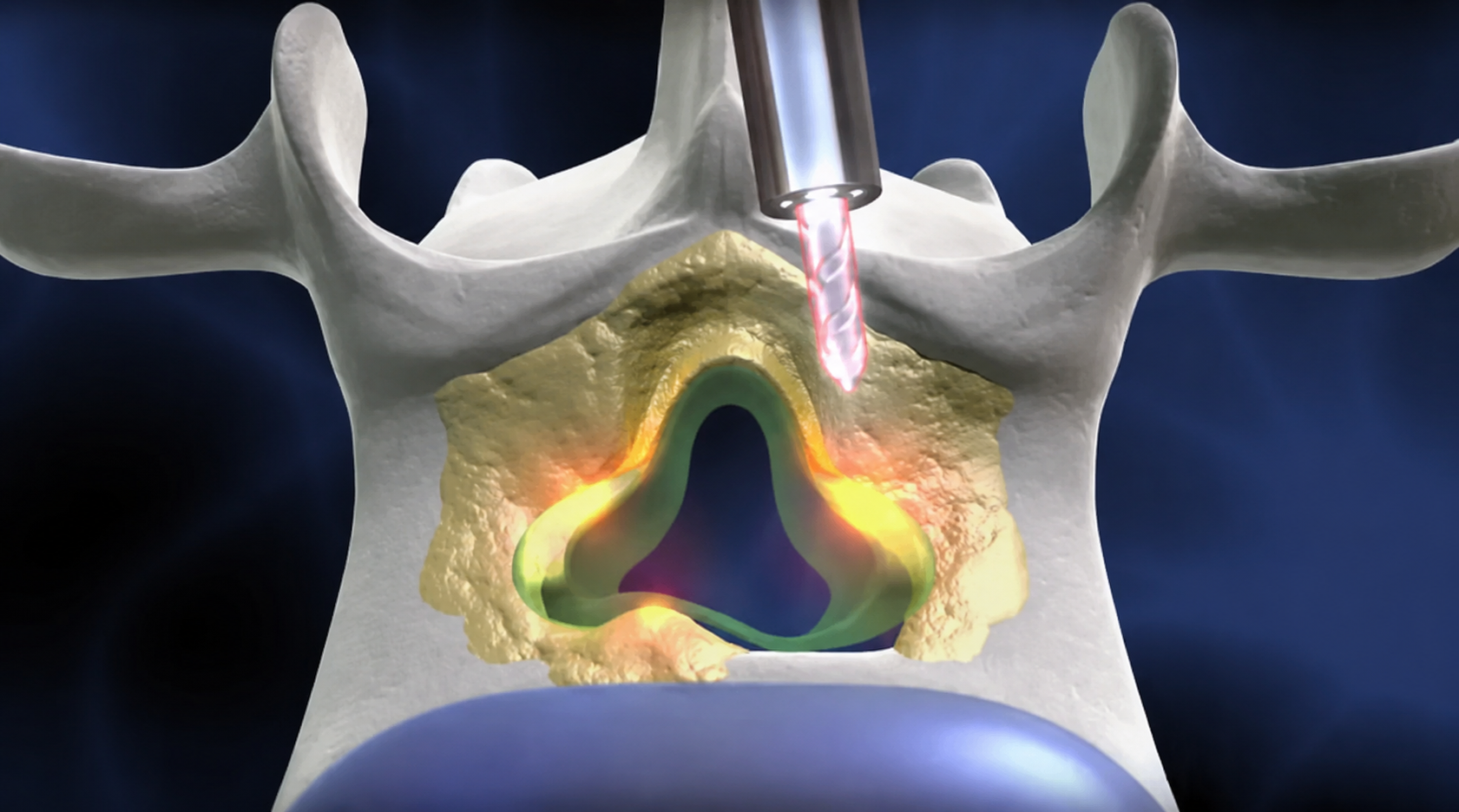 As Report Finds an Unnecessary Back Surgery Every Eight Minutes, SC Surgeon Offers Full-Endoscopic Alternative to Fusion