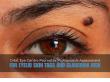 Orbit Eye Centre Promotes Professional Assessment for Eyelid Skin Tags and Glaucoma Risk
