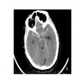 Chinese Neurosurgical Journal Reveals LVIS Stent Changes Aneurysm Blood Flow 