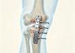 How China Orthopedic Trauma Implant Suppliers Support Hospital Procurement in the Middle East Market