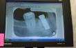 One Step Closer to Efficient Autonomous Dental Surgery