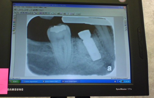 One Step Closer to Efficient Autonomous Dental Surgery