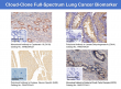 Breaking the Curse of Lung Cancer: Cloud‑Clone Paves the Path to New Life Hope in the Precision Medicine Era