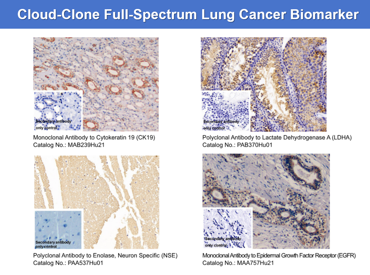 Breaking the Curse of Lung Cancer: Cloud‑Clone Paves the Path to New Life Hope in the Precision Medicine Era