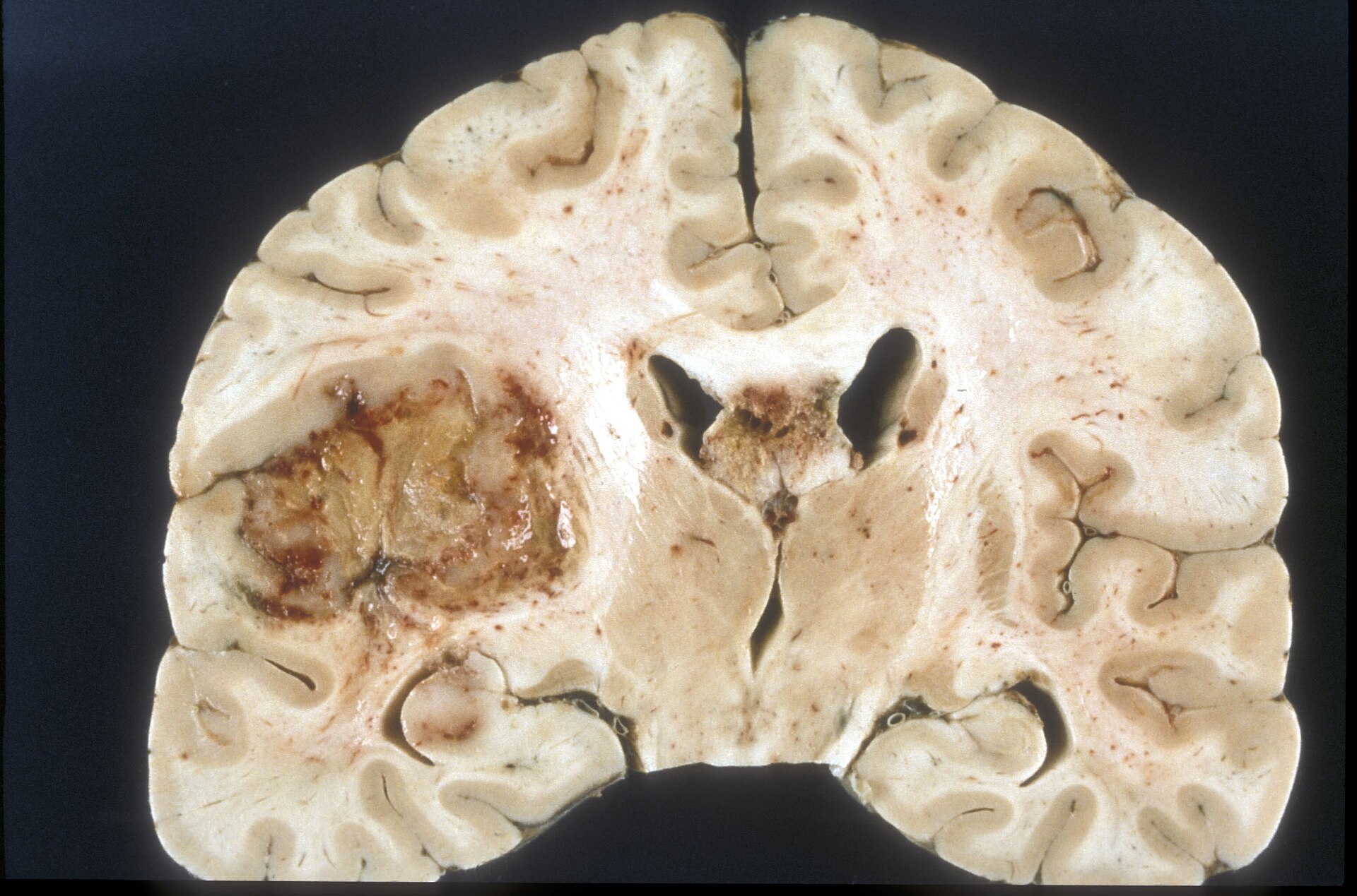 Chinese Neurosurgical Journal Reviews Explore Blood–Brain Barrier-Aware Nanomedicines for Glioblastoma