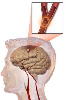 Rapamycin Shows Promise for Improving Recovery After Ischemic Stroke