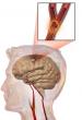 Rapamycin Shows Promise for Improving Recovery After Ischemic Stroke