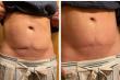 New Study Reports Significant Reduction in Postsurgical Scar Depth Following DC Microcurrent Stimulation