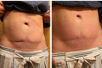 New Study Reports Significant Reduction in Postsurgical Scar Depth Following DC Microcurrent Stimulation