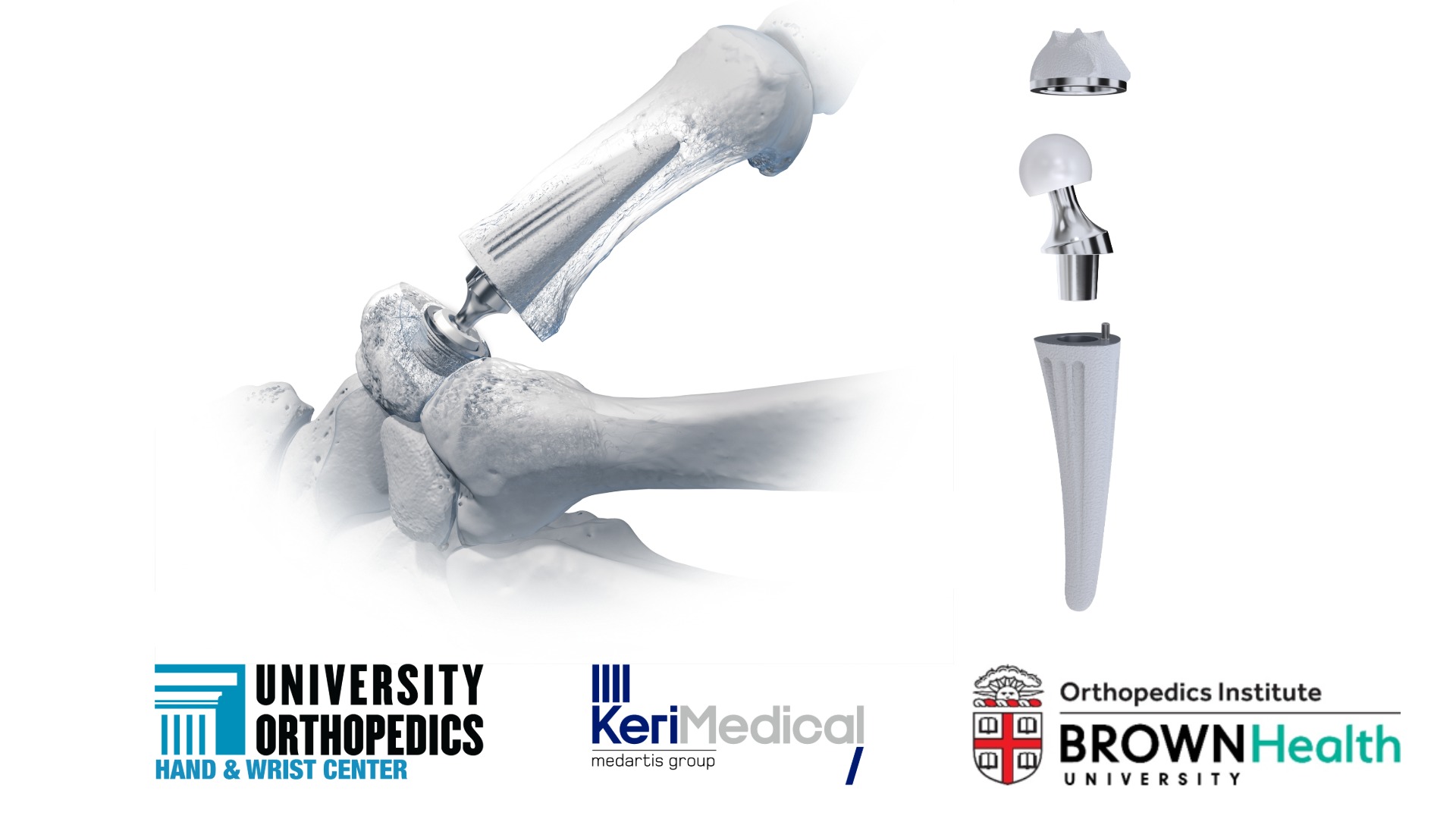 FIRST IN RI: UOI Surgeon Joseph Gil, MD, Performs Thumb Joint Replacement with Newly Available TOUCH® CMC 1 Implant