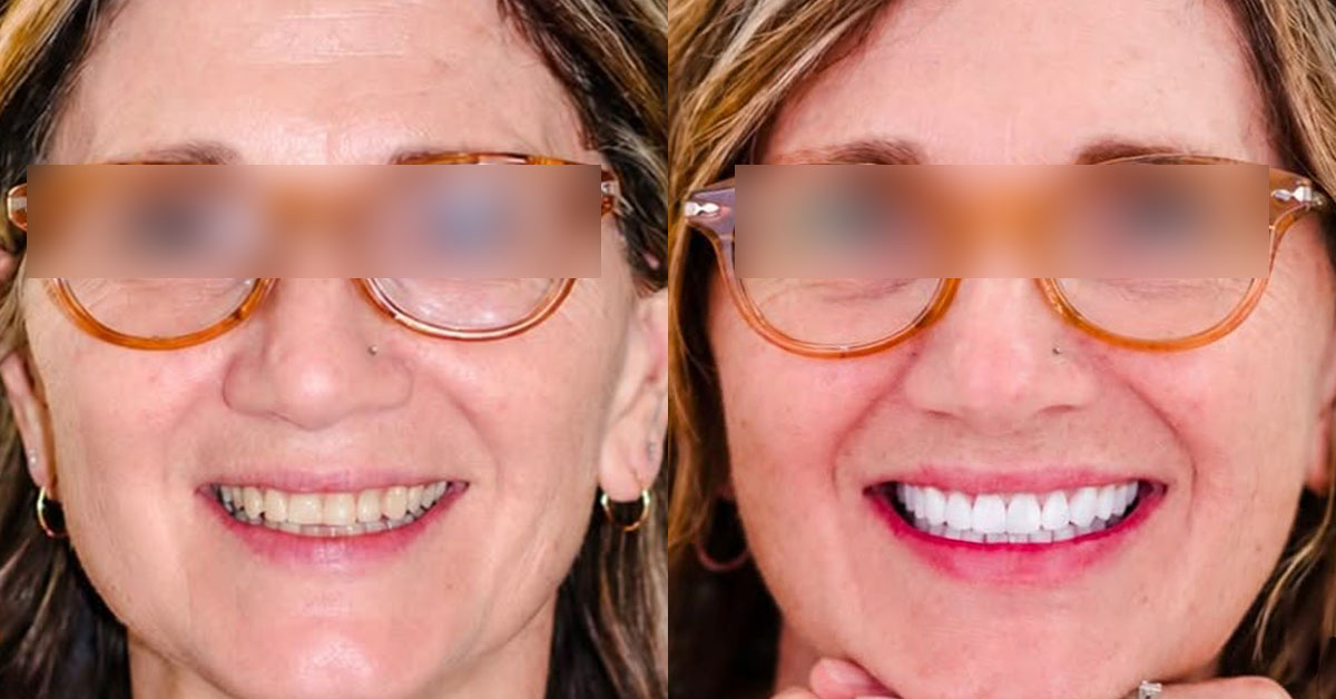 Esthetic Dentistry Puerto Vallarta Offers Same-Day Smile Makeovers Powered by Digital Dentistry Advances