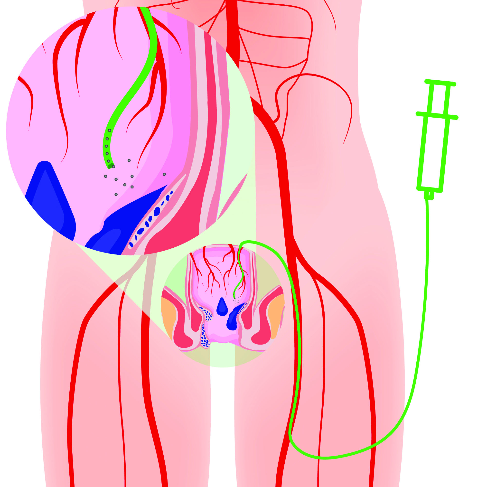 North Star Vascular & Interventional to Host Hemorrhoidal Artery Embolization (HAE) Summit Course