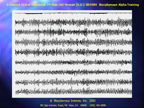 Biocybernaut Data Shows Alpha Training Reverses Brain Aging in Adults Over 70