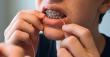 Research Finds Braces Can Triple Plaque Buildup and Sharply Raise Cavity Risk