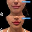 Refresh: Florida Lip Filler Searches Rise 16% as Natural Results Take Over