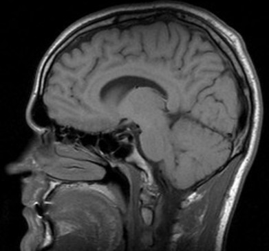 Time-Dependent Premature Suture Fusion in Craniosynostosis