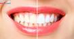 Aspley Elite Dental Care Explains Whitening Options for Fillings, Crowns and Veneers