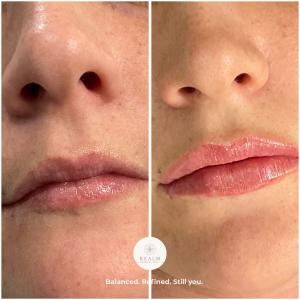 Real patient results showcasing a customized lip treatment focused on improving shape and balance while maintaining a natural, refined appearance.