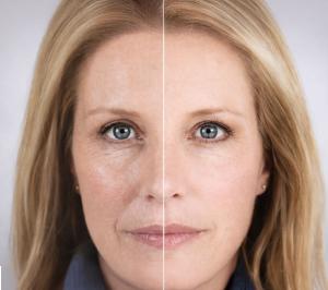 Sculptra Collagen Stimulator