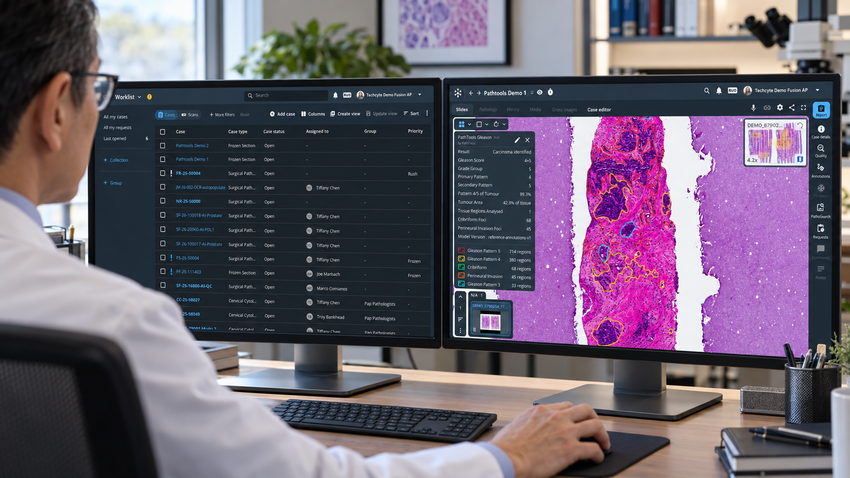 PathTools’ gland-level prostate analysis now available on Fusion AP