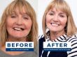 Nuvia's Newest Center in Hartford Breaks Down Cost of Full Mouth Dental Implants and Financing