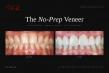 Dr. Pia Lieb Publishes No-Prep Veneer Candidacy Guidance