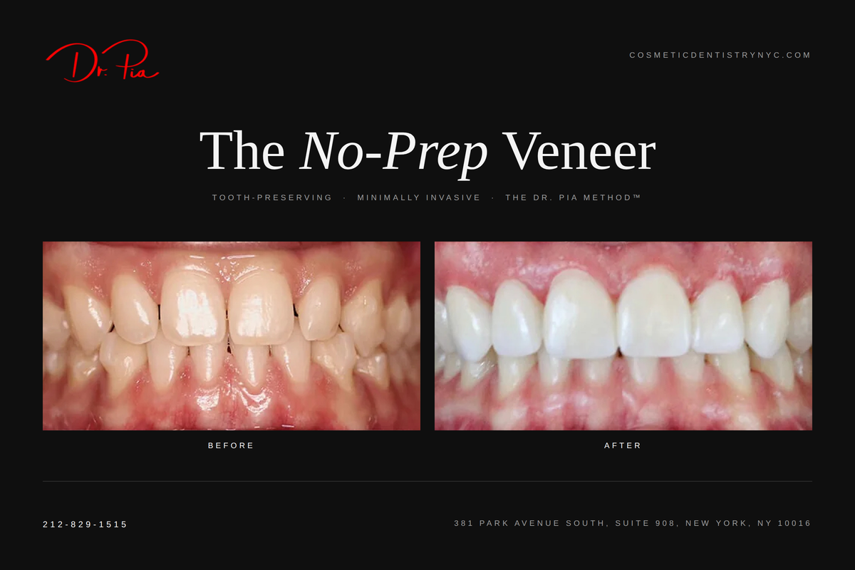 Dr. Pia Lieb Publishes No-Prep Veneer Candidacy Guidance