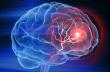 Global Stroke Burden Keeps Rising Despite Falling Stroke Rates