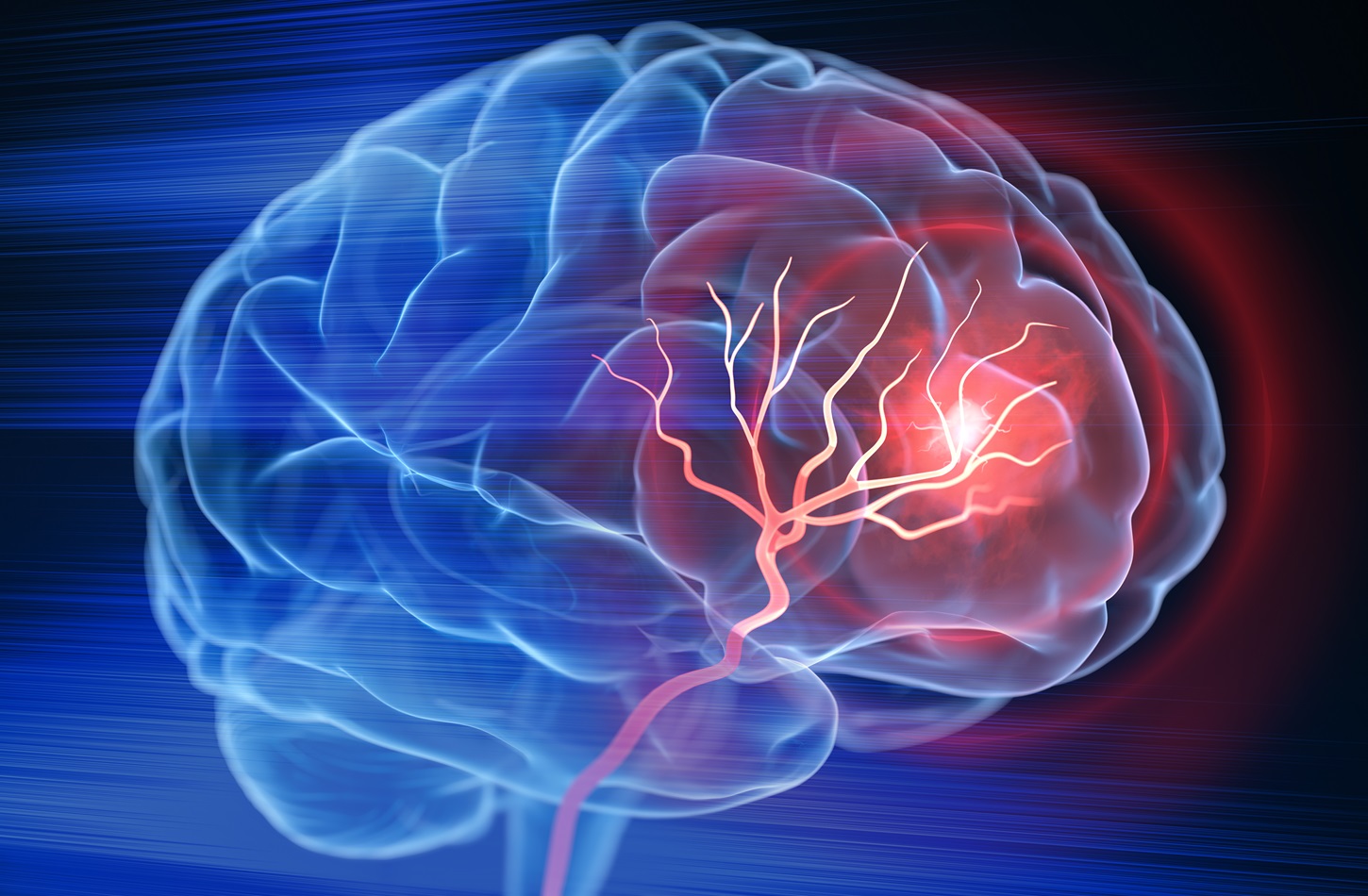 Global Stroke Burden Keeps Rising Despite Falling Stroke Rates