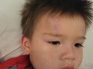 Injuries Sustained By Mr. Peer's two year old son as a result of debris left behind