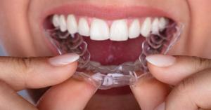 Clear Braces For Teeth Straightening