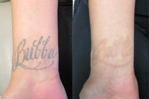 Not-so-proud tattoo owners could soon find themselves freed of their dodgy inks pain-free and at home
