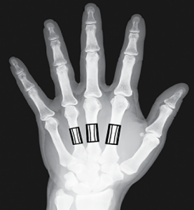 OsteoApp.ai can determine bone density using standard x-rays of the hand and forearm.