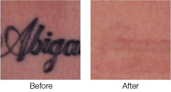 Get A Tattoo Removed  Tattoo Removal Ink