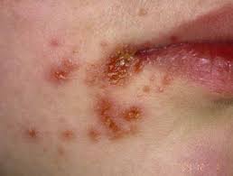 Impetigo is very common and contagious skin infection disease that generally affects infants and children Impetigo Treatment
