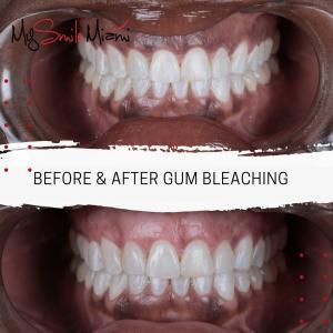 Dr. Grisel Martos, a cosmetic dentist in Miami, Introduces gum bleaching. 2